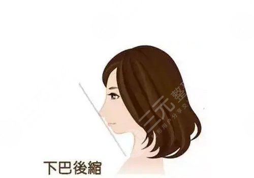 下頜骨手術費用大概多少