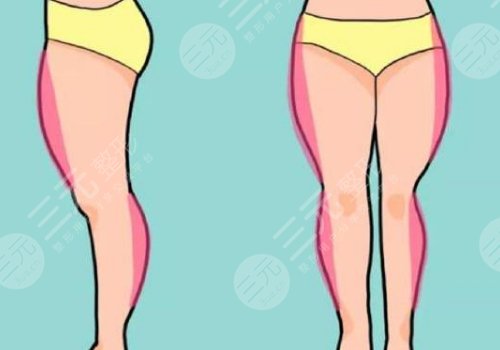 大腿抽脂費用