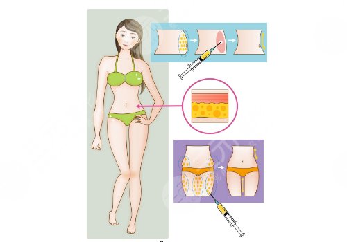 大腿抽脂費用