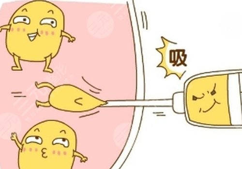 大腿抽脂費用