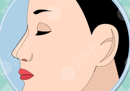 隆鼻膨體價(jià)格一般要多少