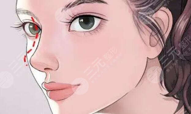 歪鼻矯正