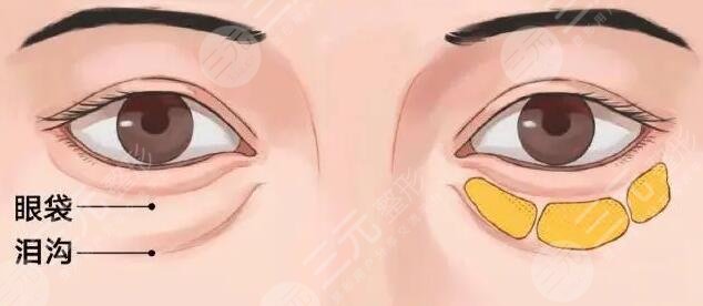 除淚溝