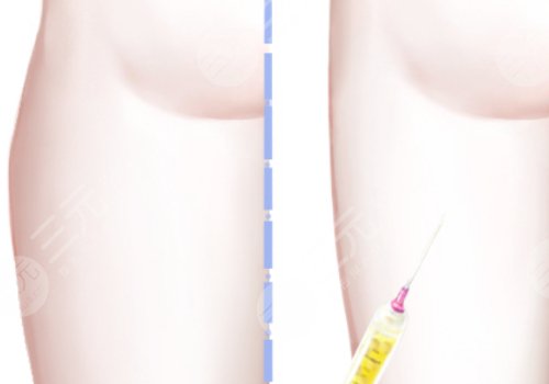 大腿吸脂手術