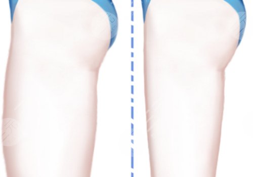 大腿吸脂手術