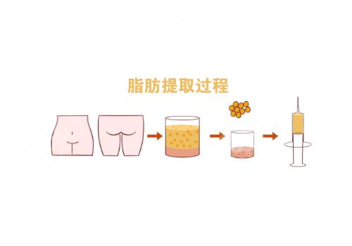面頰填充用什么填充比較好