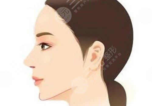 墊下巴好不好