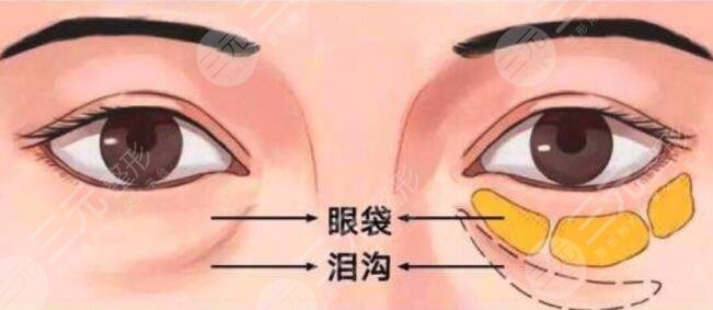 寧波市第六醫(yī)院整復(fù)外科祛眼袋多少錢?