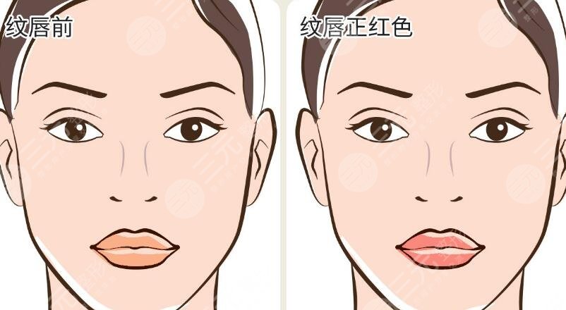 紋唇手術(shù)