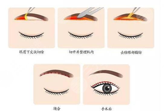 隆眉弓