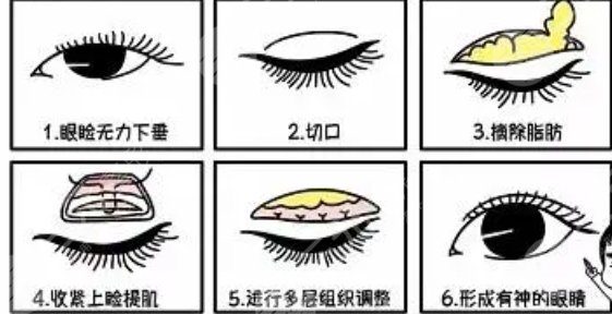 雙眼皮修復