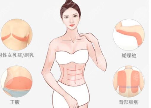 蝴蝶袖吸脂
