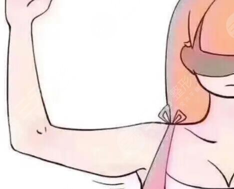 蝴蝶袖吸脂