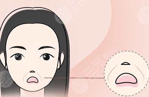 填充法令紋