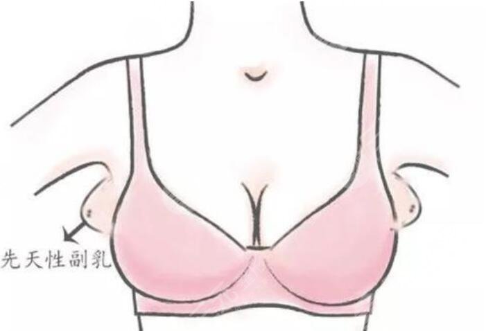 去副乳