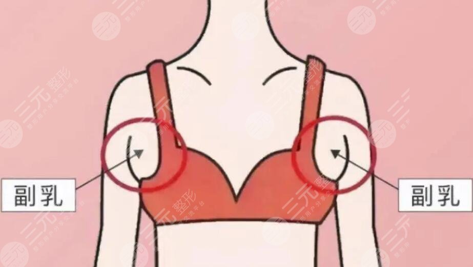 去副乳