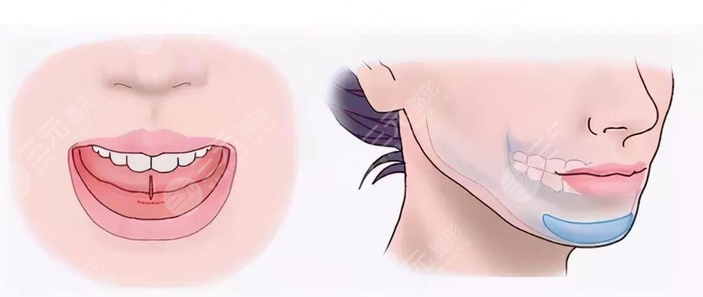 瘦下巴