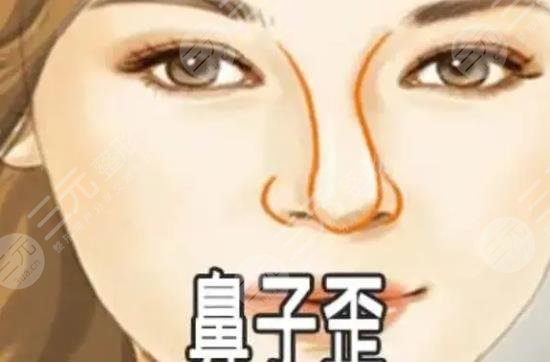歪鼻