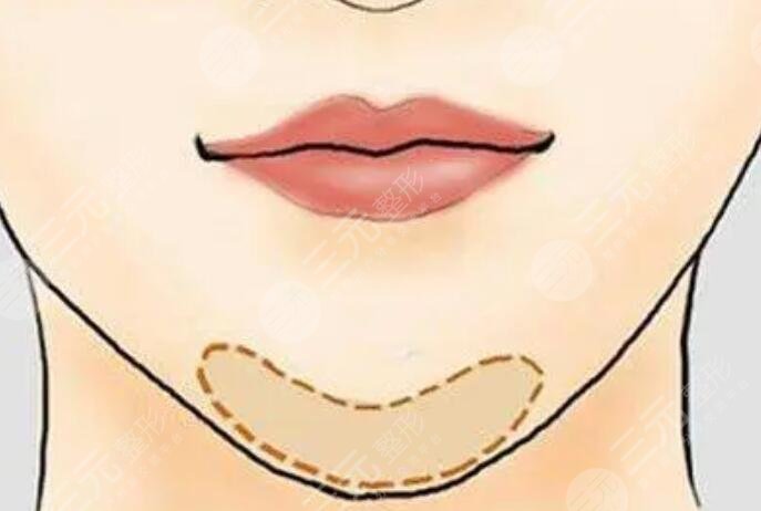瘦下巴