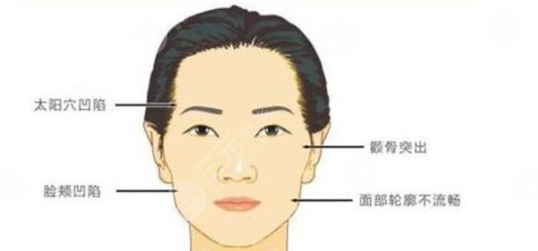 顴骨內(nèi)推