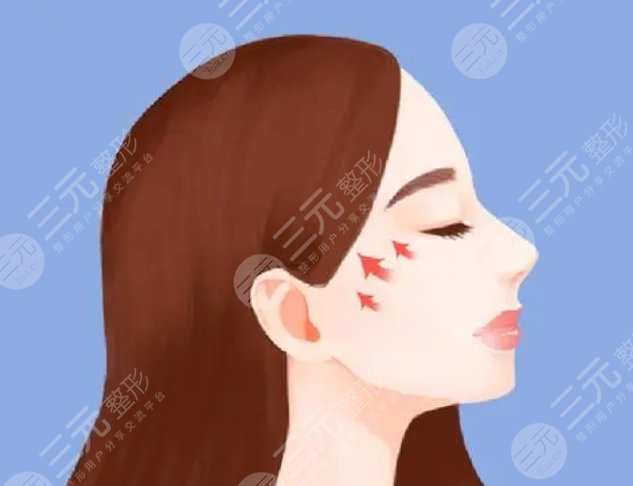 顴骨內推