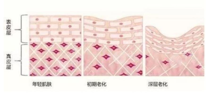 注射除皺