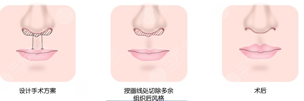 人中縮短