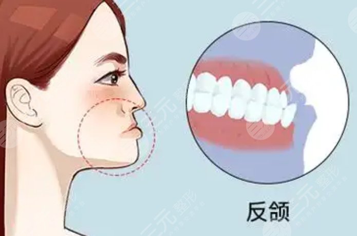 反頜矯正手術