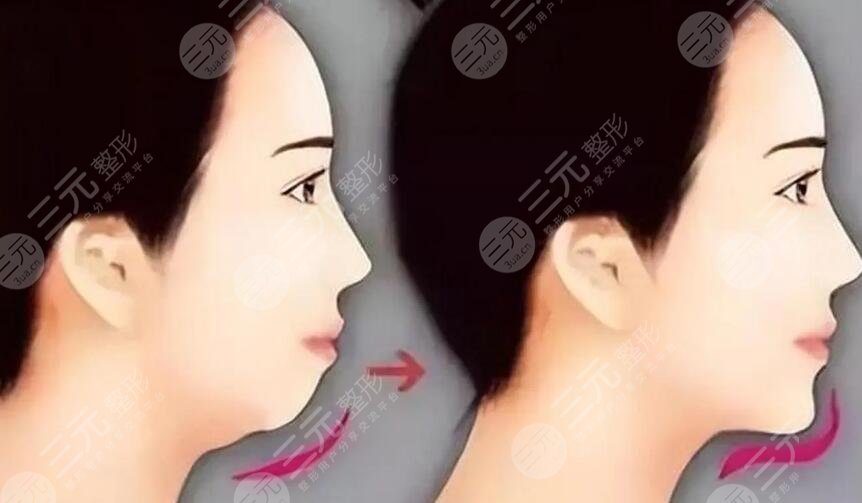下巴放松針