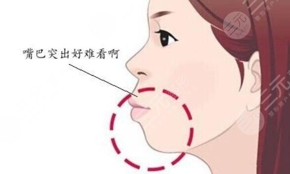 下巴放松針
