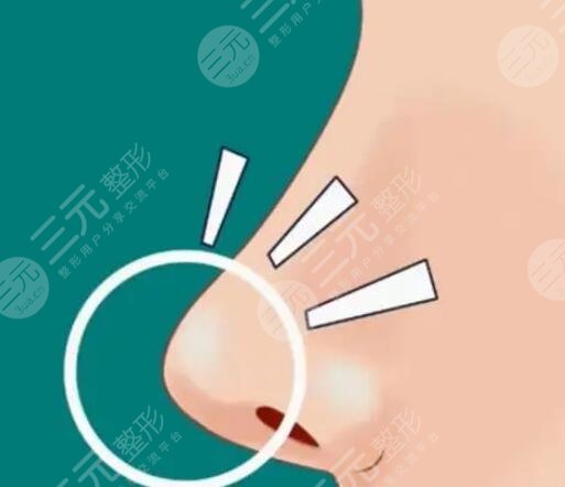 鼻尖塑形