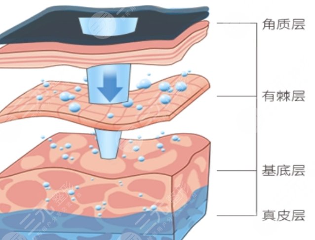 滾輪微針