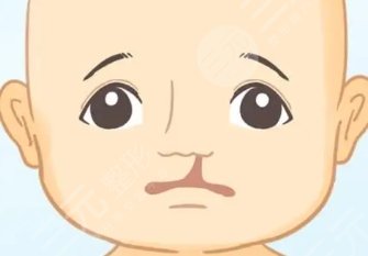 唇腭裂鼻孔一大一小
