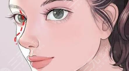 歪鼻矯正