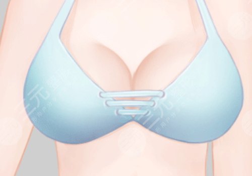 南方醫(yī)院隆胸價(jià)格是多少