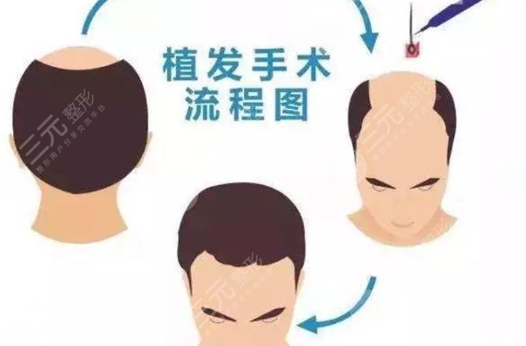 植發(fā)