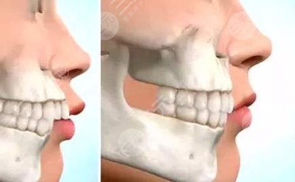 正頜手術