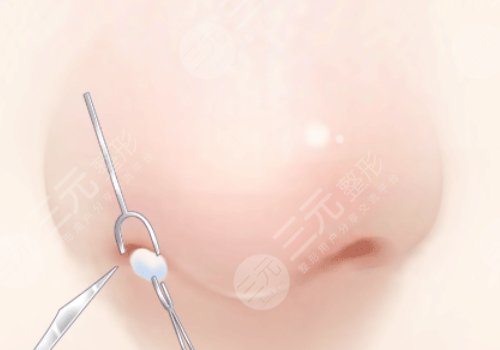 長(zhǎng)沙華韓鄧穎縮鼻翼技術(shù)可以嗎