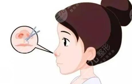 隆鼻
