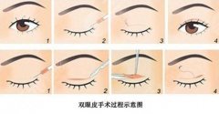 成都割雙眼皮哪個(gè)醫(yī)生好？盧尚兵、楊建、唐勇等技術(shù)點(diǎn)評！