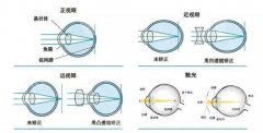 上海近視手術(shù)價(jià)格指南：從萬元飛秒到4萬晶體，你的“清晰視界”值多少？