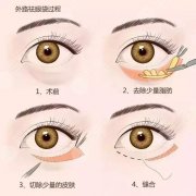 上海割眼袋哪個(gè)醫(yī)院好？5家公立整形科讓你告別“疲憊臉”
