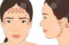 面部提升緊致打什么針？有什么好的方式？科普知識匯總！