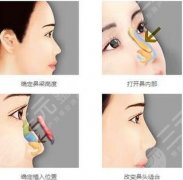 上海藝星做鼻子價(jià)格全攻略：1.6萬(wàn)到8萬(wàn)，這樣選不踩坑！