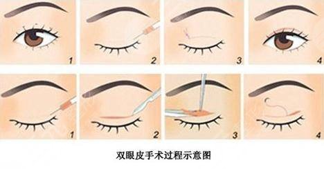 青島割雙眼皮