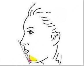 頦成型和假體隆下巴，到底哪種好?