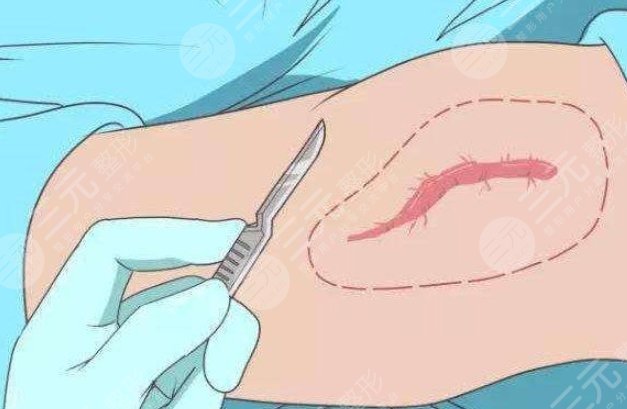 大腿疤痕