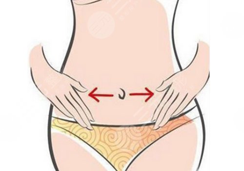 上海曹衛(wèi)剛做腹壁成形術