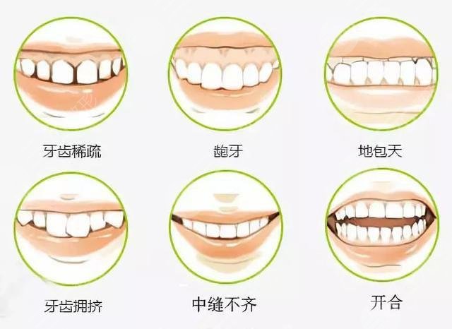 舌側(cè)矯正和傳統(tǒng)矯正哪個(gè)好？暑期正畸必看攻略！